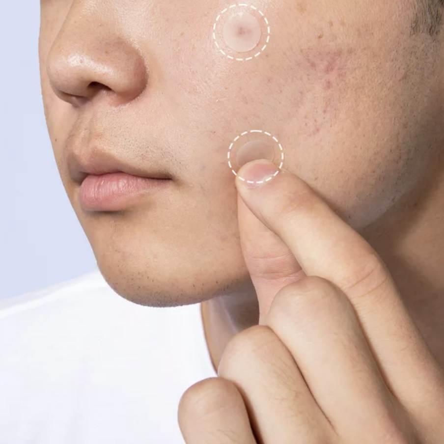 The model is placing a pimple patch on their cheek and there is a dashed circle around it and other already placed to draw attention to them