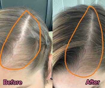 Reviewer's hair with thinning hair and after using product with fuller scalp