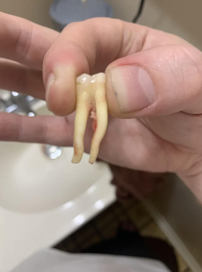 Someone holding up a tooth