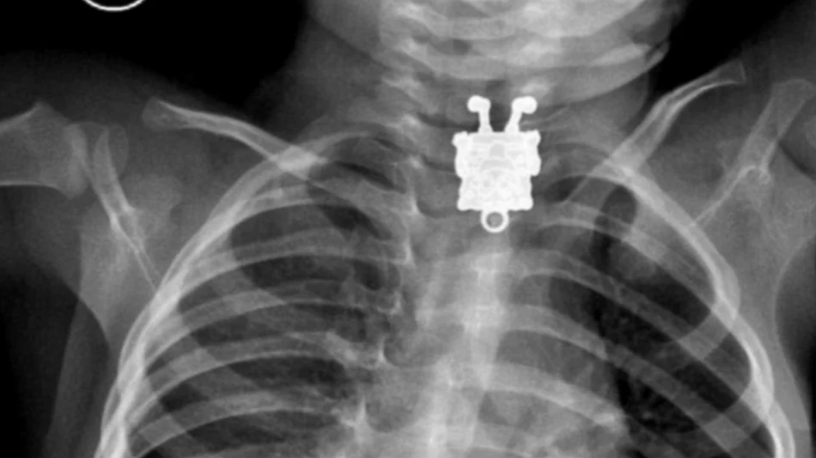 A key chain in front of lungs in an X-ray