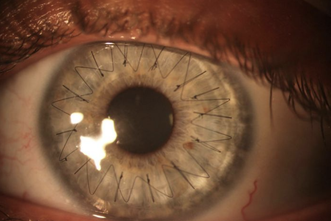 Close-up of an eye with sutures around the iris