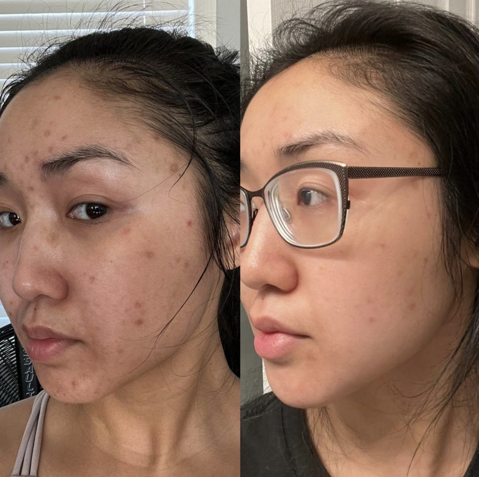 reviewer showing their skin before and greatly improved after using the snail mucin