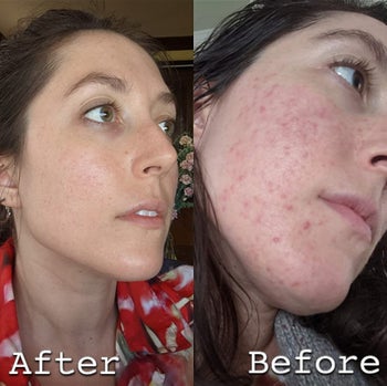reviewer before and after, showing their red, irritated skin with acne and then their clearer skin, from using the cerave cleanser