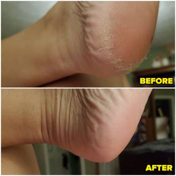A reviewer shows before and after using the mask with calluses now removed