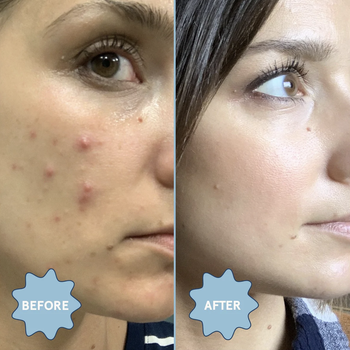 A photo showing visible acne on a model's face, followed by a photo of the same model with much clearer skin after using the acne oil