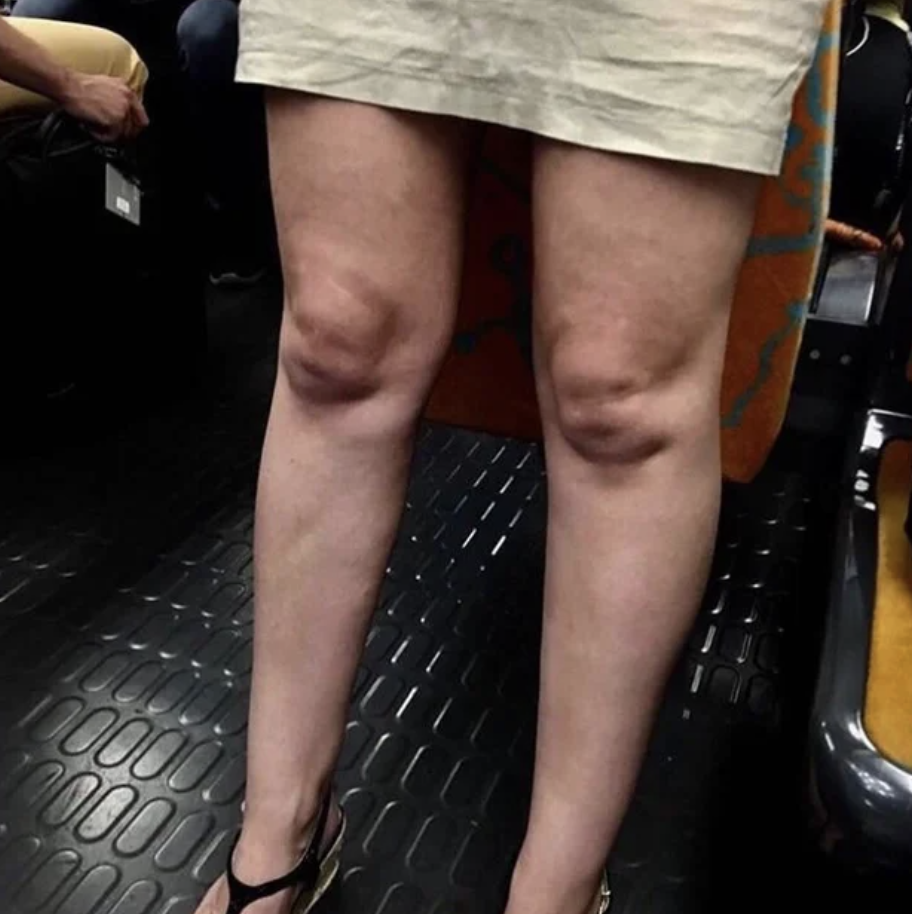 Closeup of a woman&#x27;s knee caps