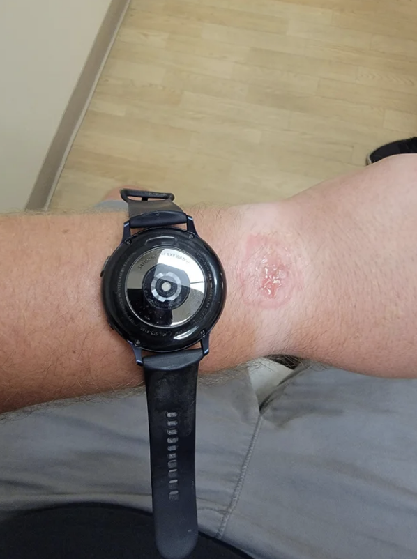 burn mark on the wrist where the watch was