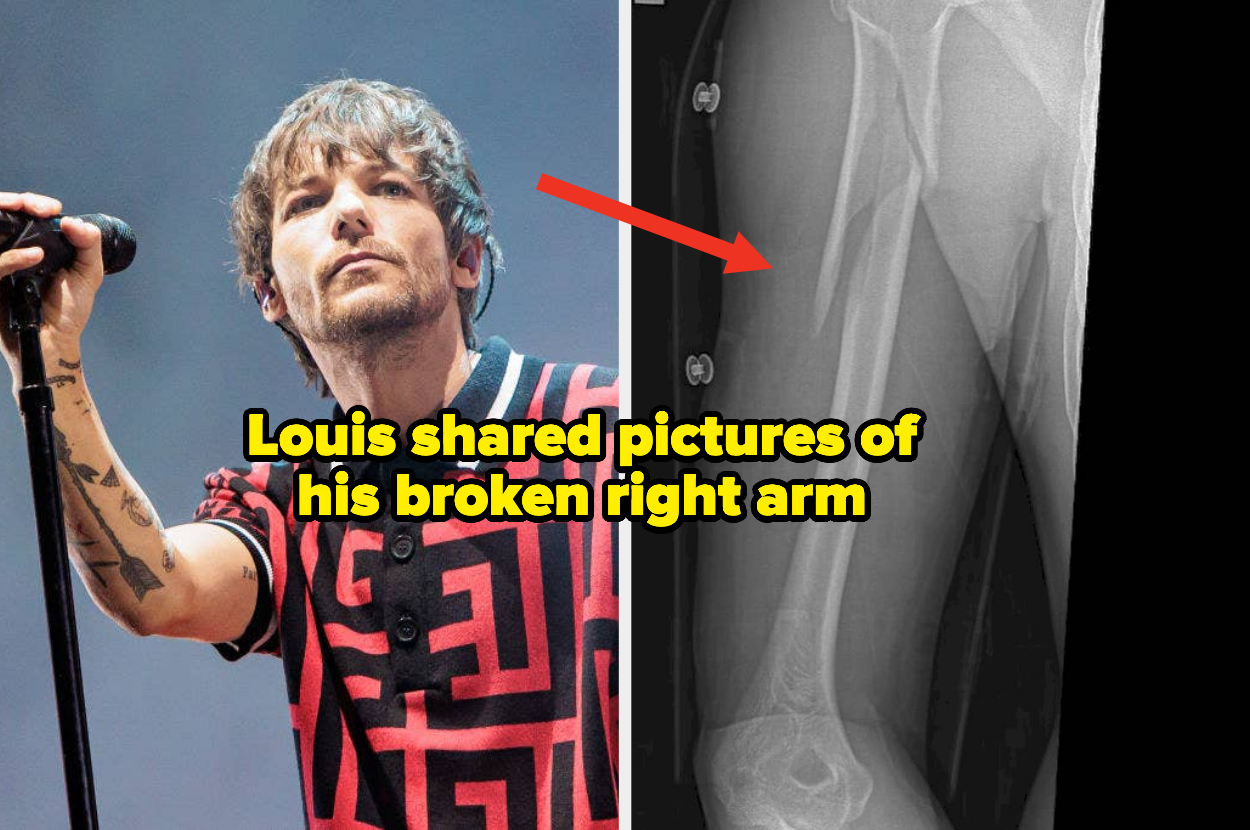 Louis Tomlinson breaks arm after NYC show at Irving Plaza