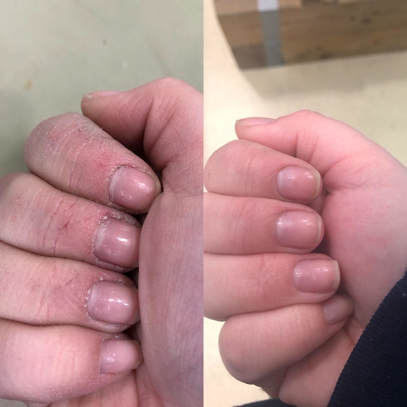 A split image of a reviewers cracked dry hands before using hand cream and moisturized hands after using hand lotion