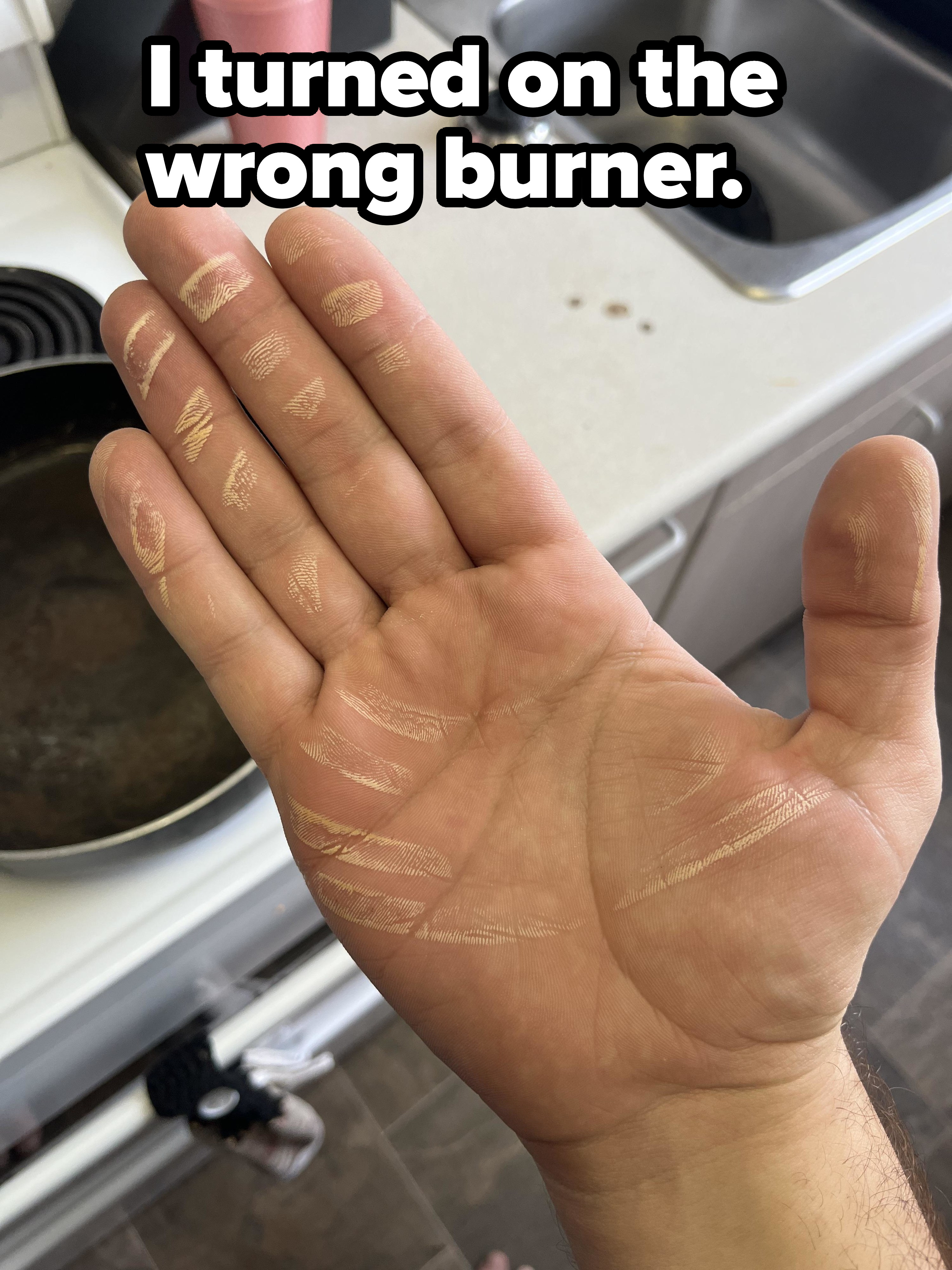 A hand with marks from a stove