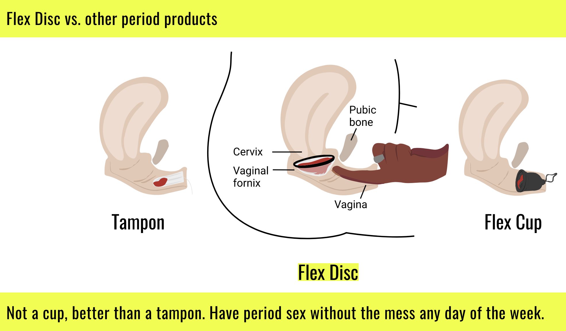 Diagram comparing the insertion and placement of tampons, flex discs and the flex cup