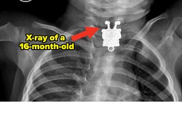 An X-ray of a 16-month-old child who swallowed a keychain