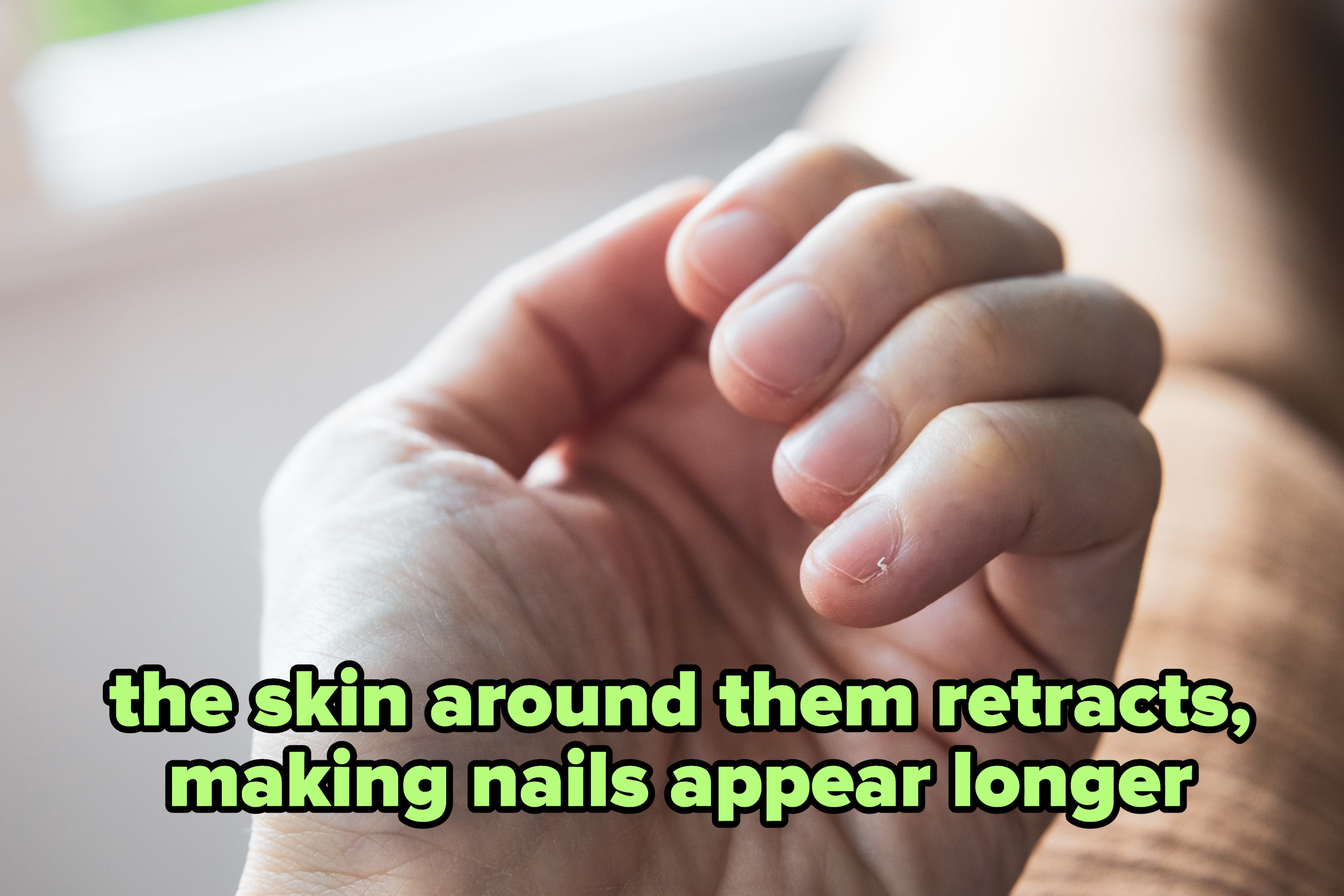 的手指甲上的标题,“他们周围的皮肤收缩,使指甲显得longer"