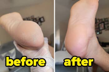 before and after of a calloused foot made smooth