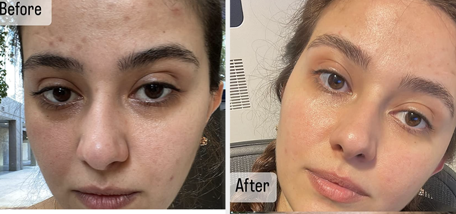 Reviewer before pic with acne and after pic with skin clear