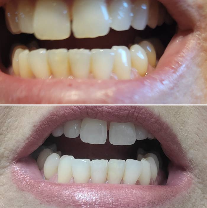reviewer before and after using teeth whitening pens on teeth
