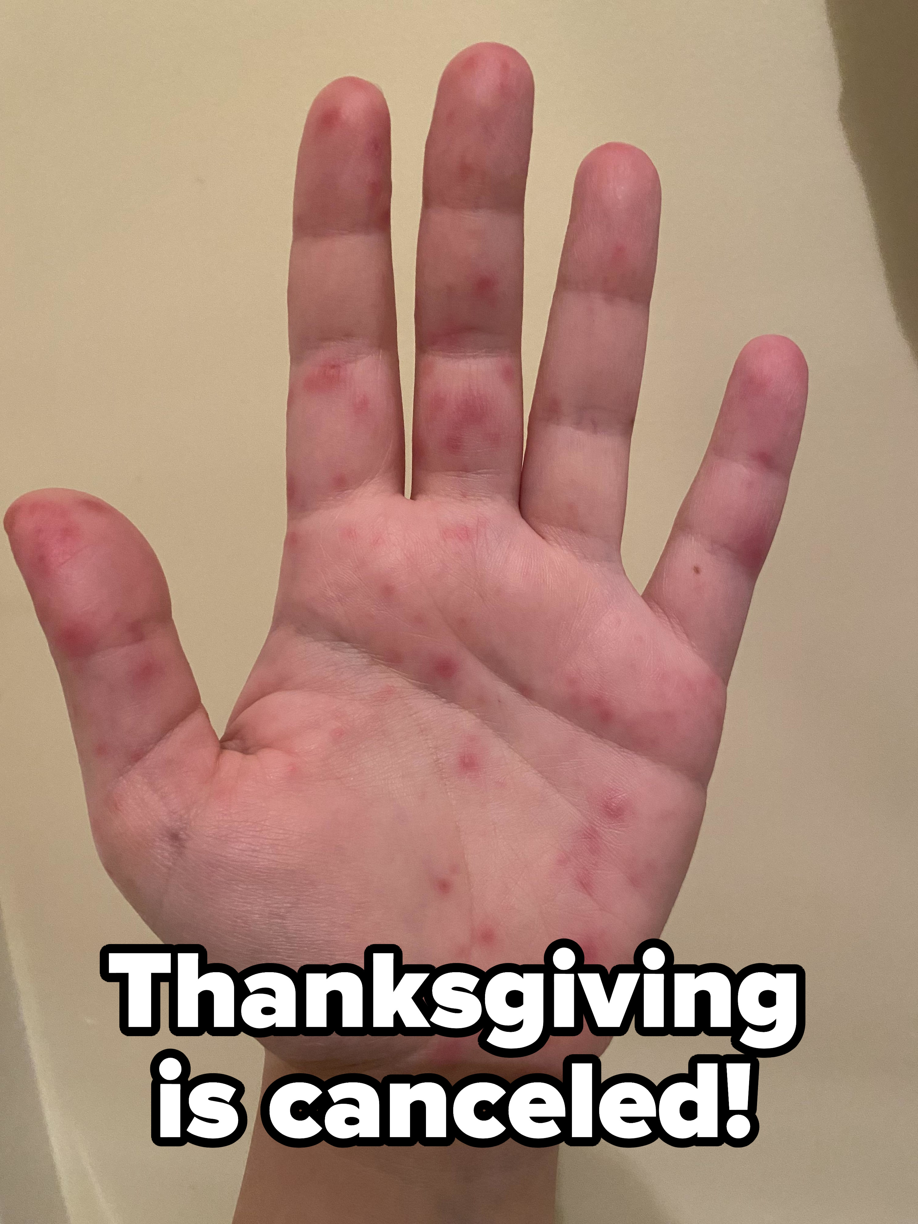 A hand with lesions and red blotches on it with the caption &quot;Thanksgiving is canceled!&quot;
