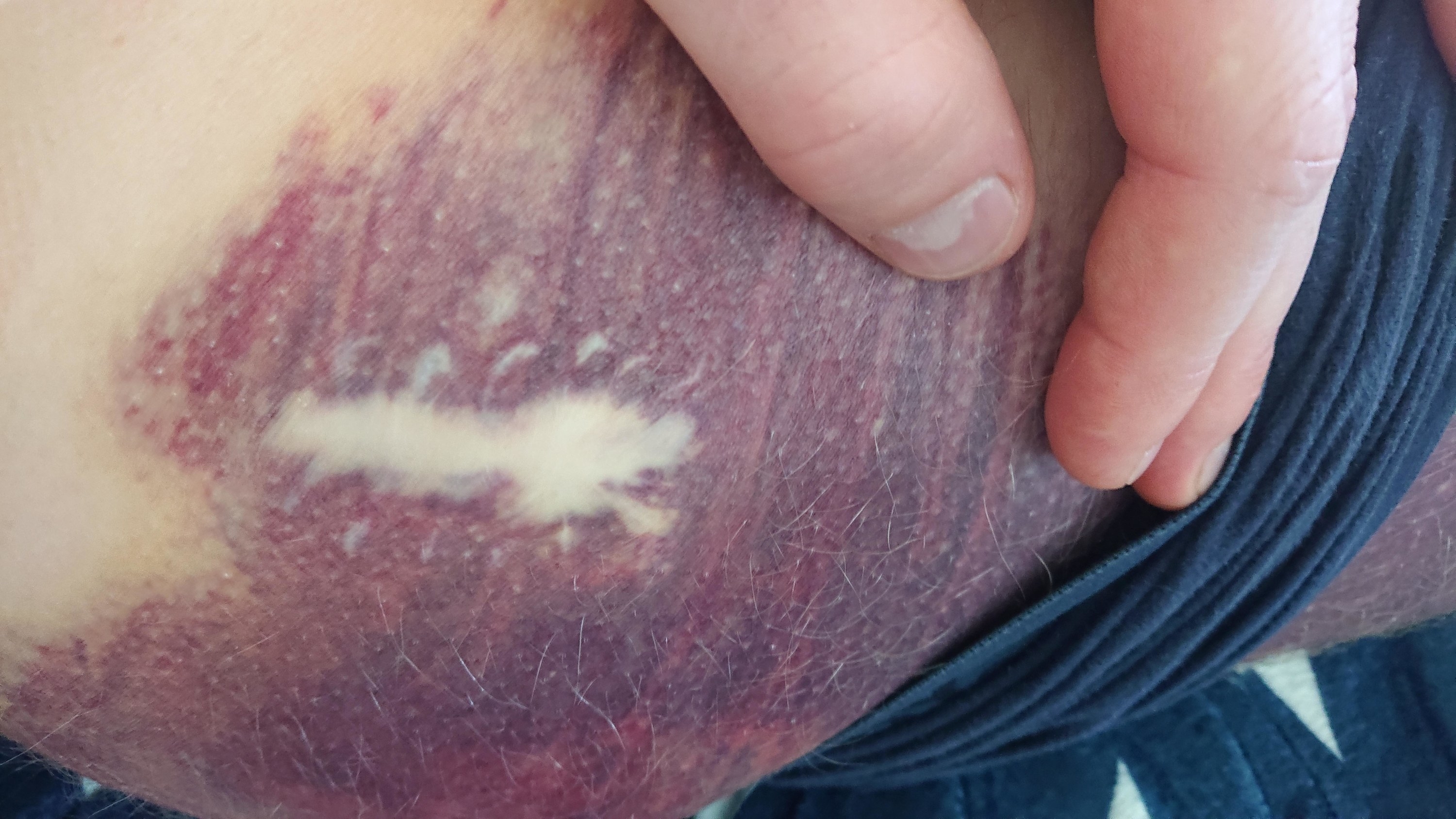 A large purplish bruise with an unbruised section