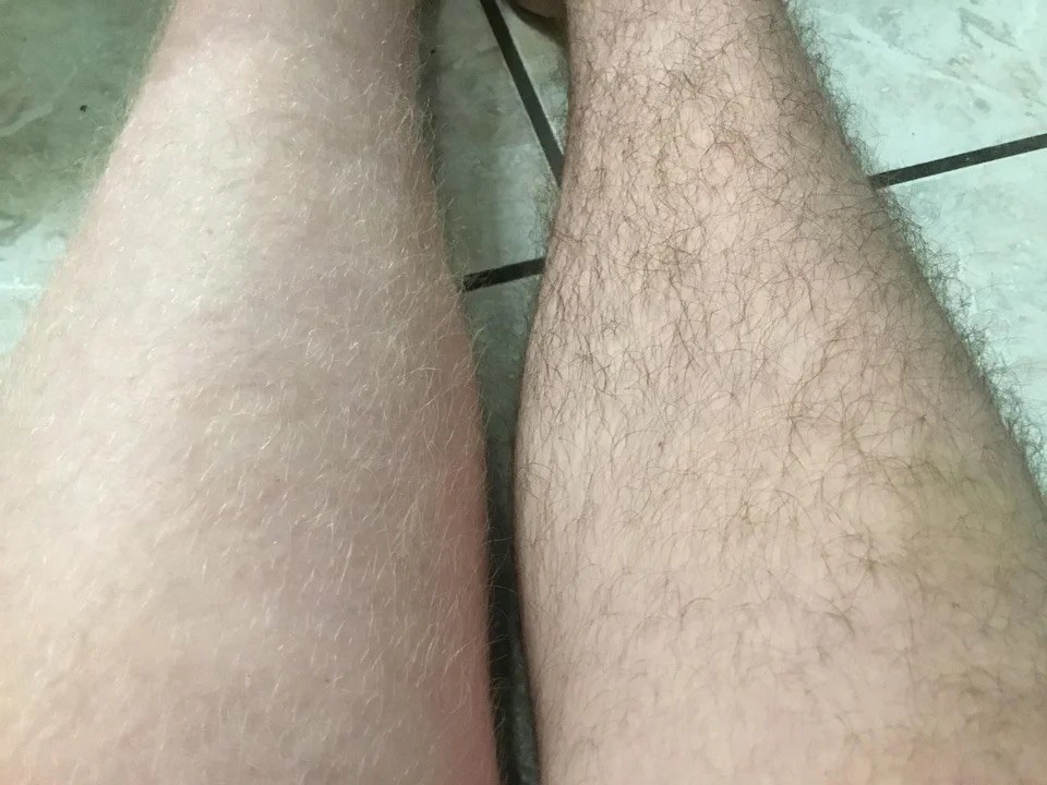 A person with two different colored leg hairs
