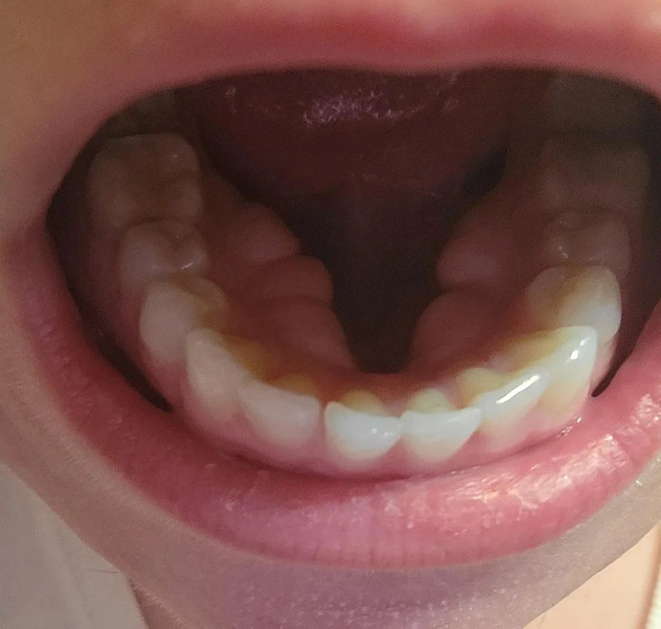 A person with their mouth open showing another set of teeth, just below the gums inside the bottom of their mouth