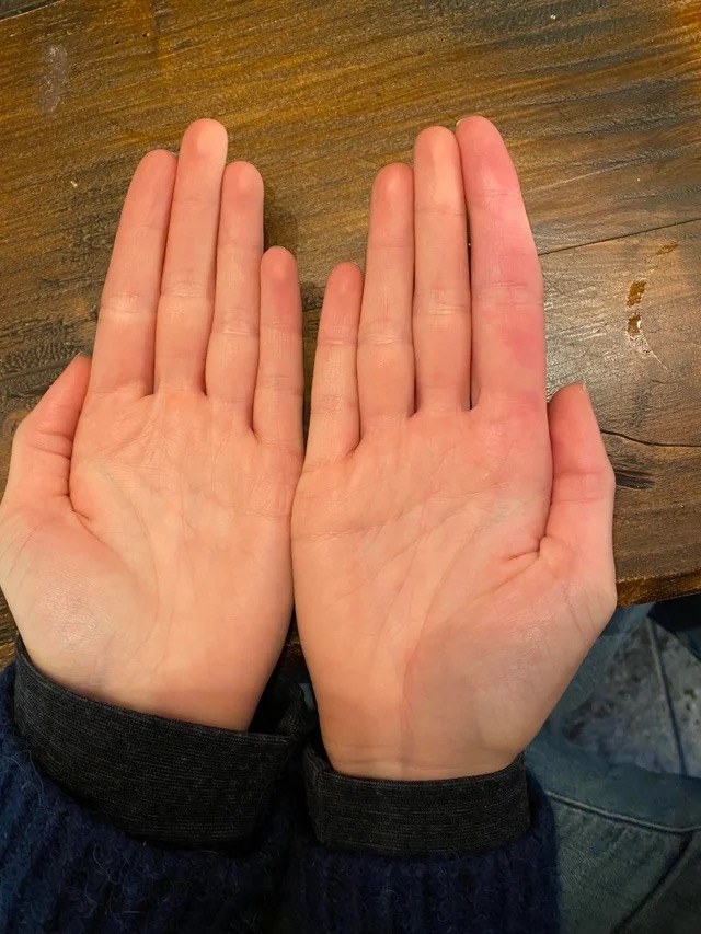 A person whose right hand has a really long index finger longer than all their other fingers