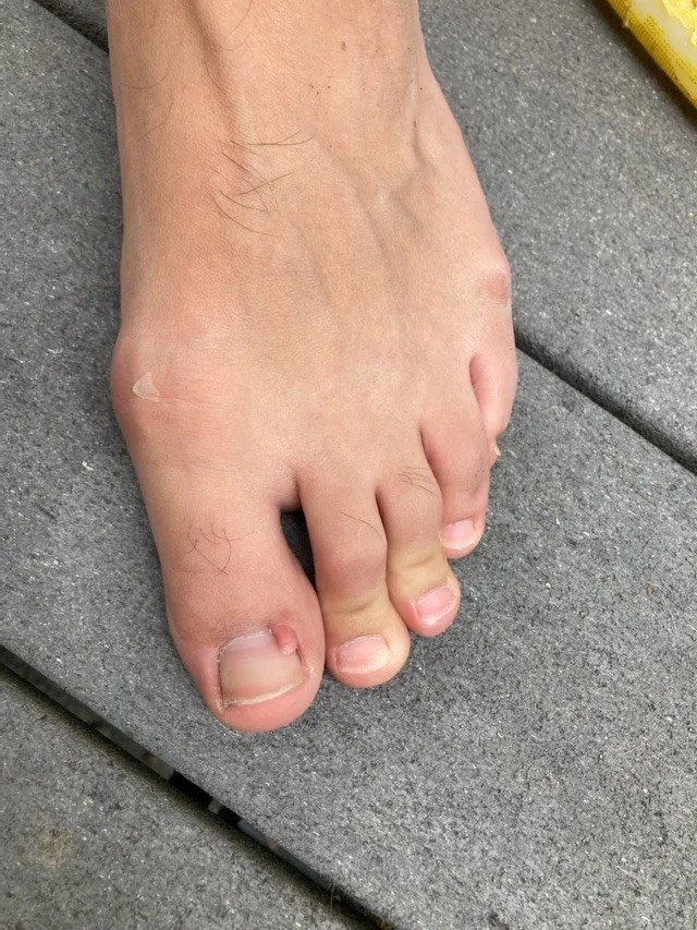 A person&#x27;s foot showing the big toe with a small growth near the quick that looks like a miniature toe