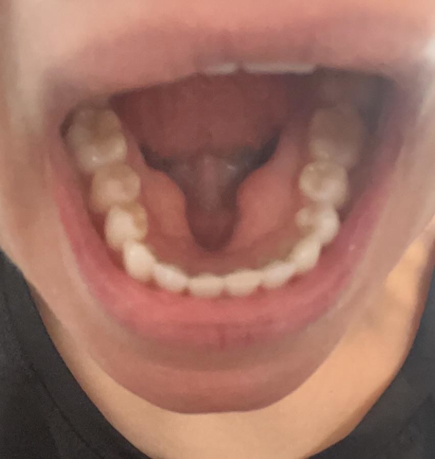 A person showing the inside of their mouth that has a deep gap at the bottom
