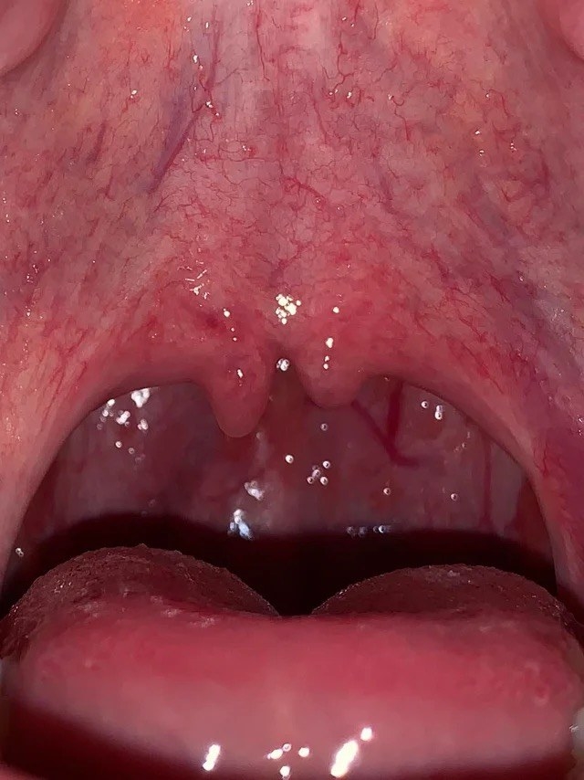 A person with their mouth open revealing a split uvula