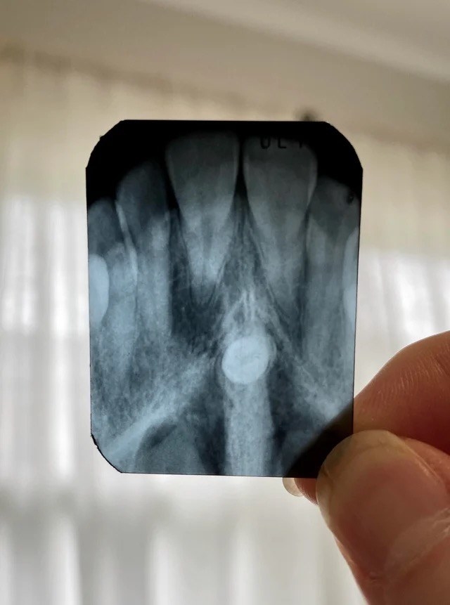 An x ray of a person&#x27;s mouth showing a tooth in the middle of the roof of their mouth