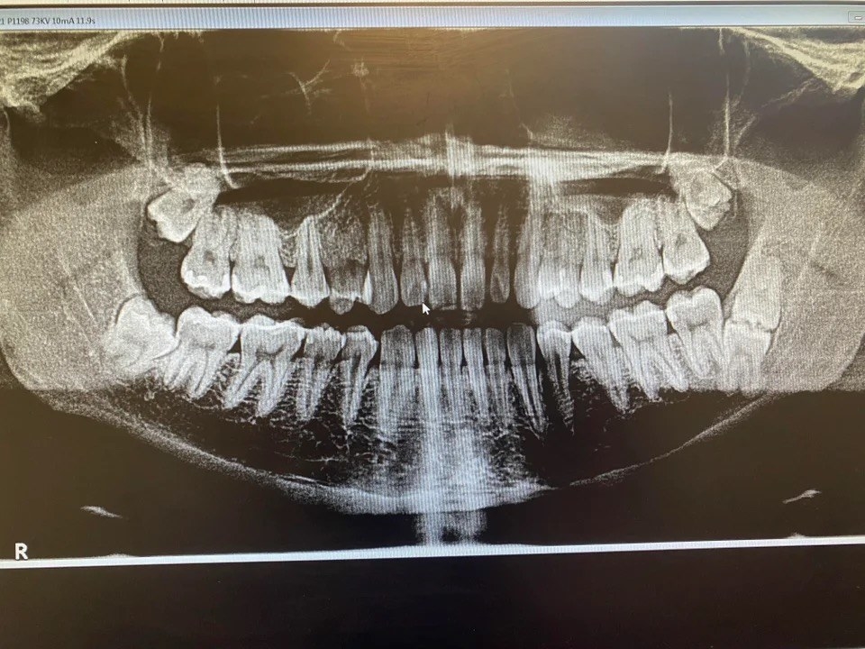 An x ray showing a full scan of someone&#x27;s mouth and 2 wisdom teeth on the bottom right where there should be just one