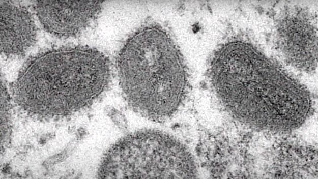While no official cause of death will be declared until an investigation is done, authorities said this was the first death of someone with monkeypox.