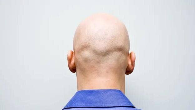 Insulting a man for being bald in the workplace amounts to sexual harassment in the United Kingdom, a panel of judges who also experienced hair loss ruled.
