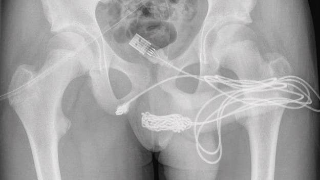 An unnamed UK-based teenager reportedly had to undergo emergency penis surgery after he somehow managed to insert a whole USB cable into his urethra.