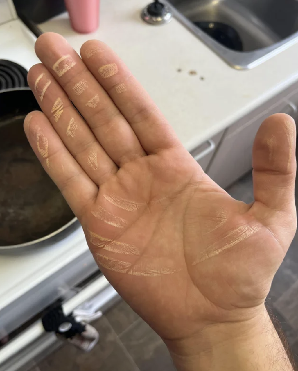Someone&#x27;s hand with marks from the stove