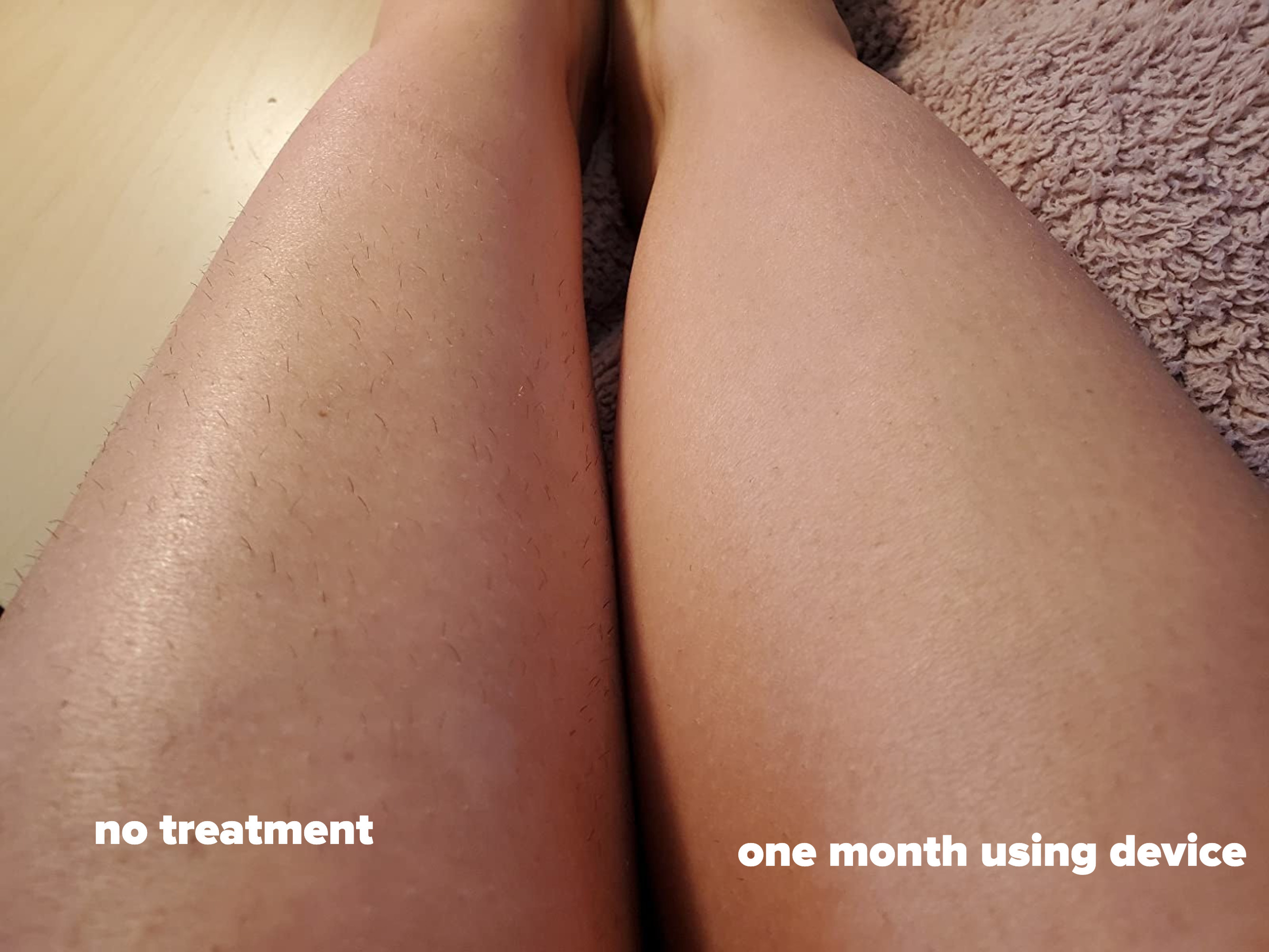 reviewer&#x27;s before and after of leg with hair and leg with no hair