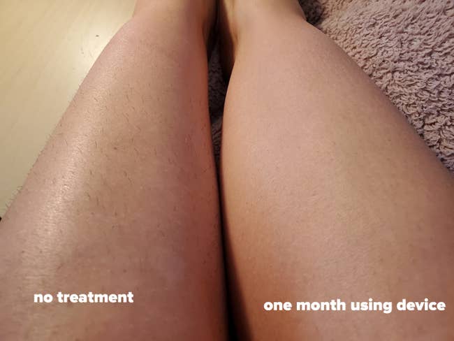 reviewer's before and after of leg with hair and leg with no hair