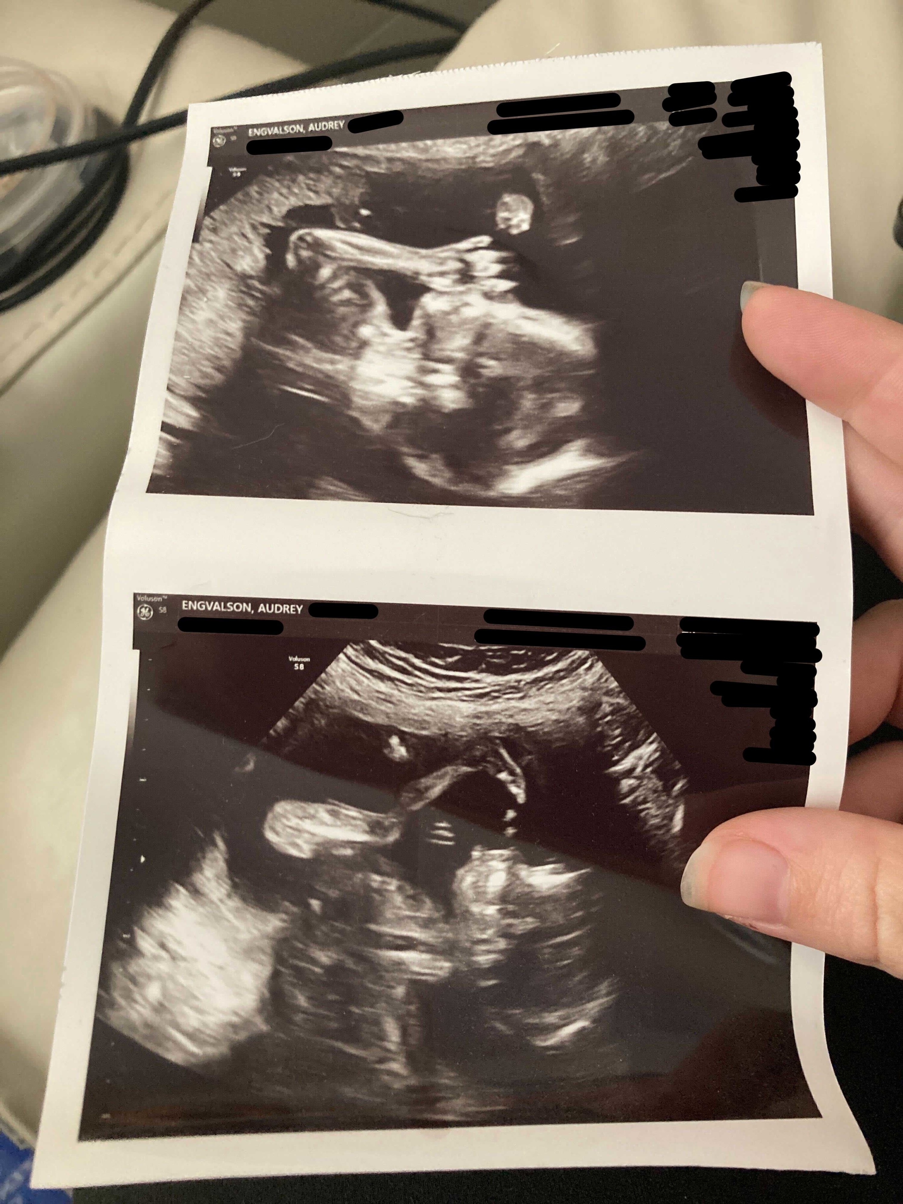 ultrasound photos