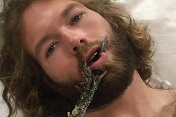 A snowboard instructor who had a branch impale his face.