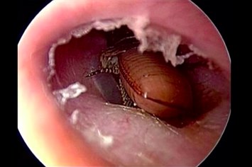 Cockroach in ear