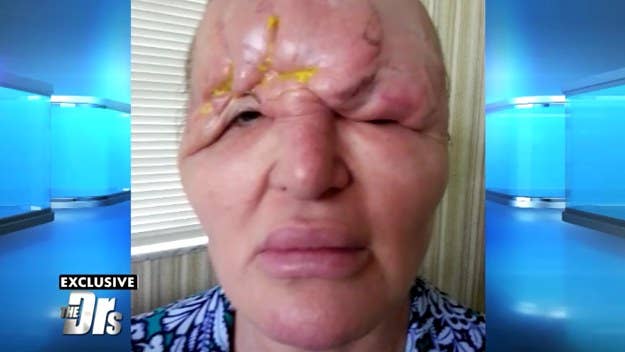 One woman is taking her story public after "botched" facial fillers turned her into a recluse.