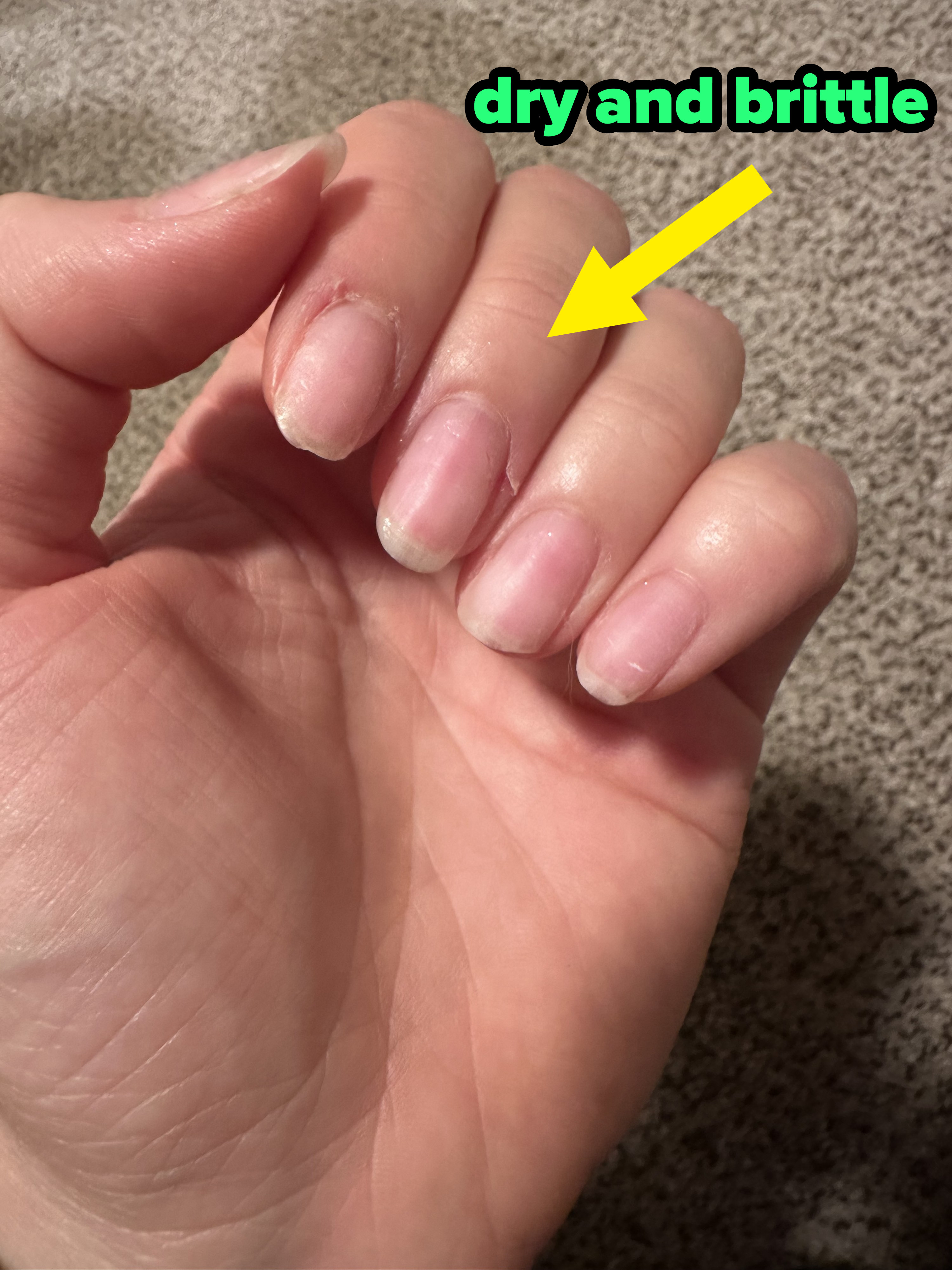 Home Remedies To Get Rid Of Brittle Nails