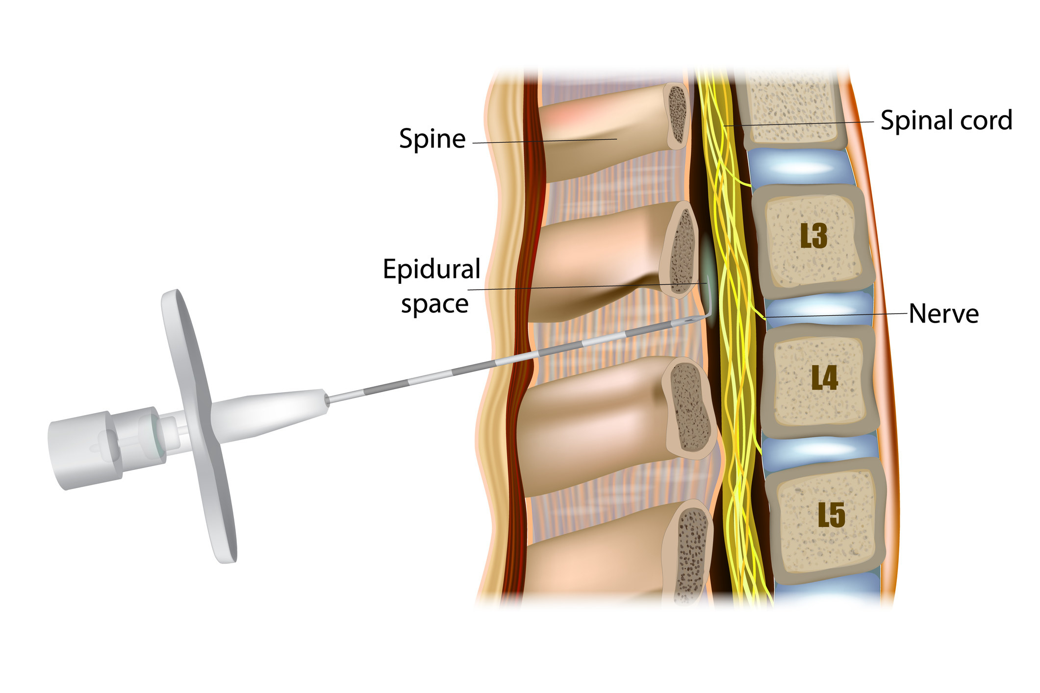 An illustration of a needle being inserted into the epidural space by the spinal cord