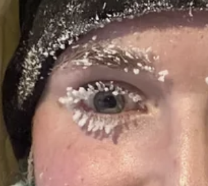 Ice in someone&#x27;s eyelashes and eyebrows