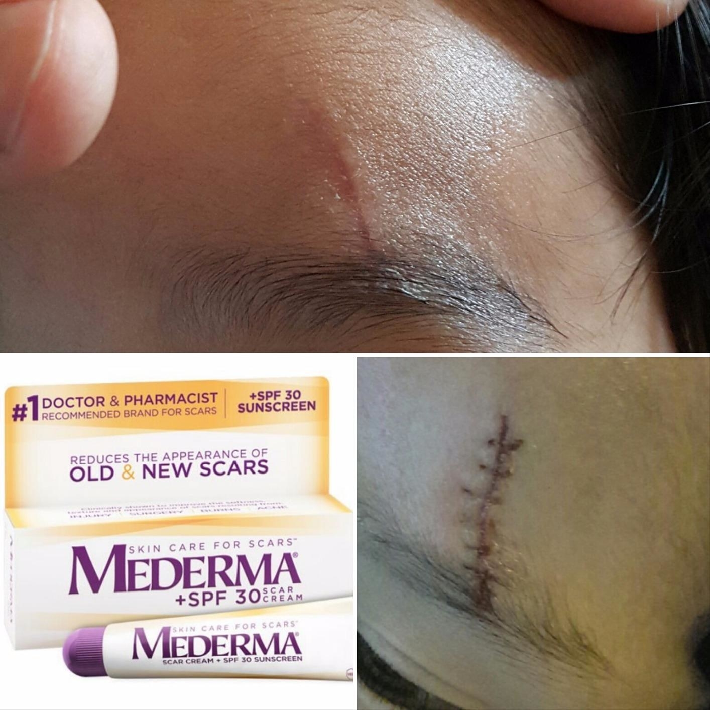 reviewer scar before and after using Mederma cream