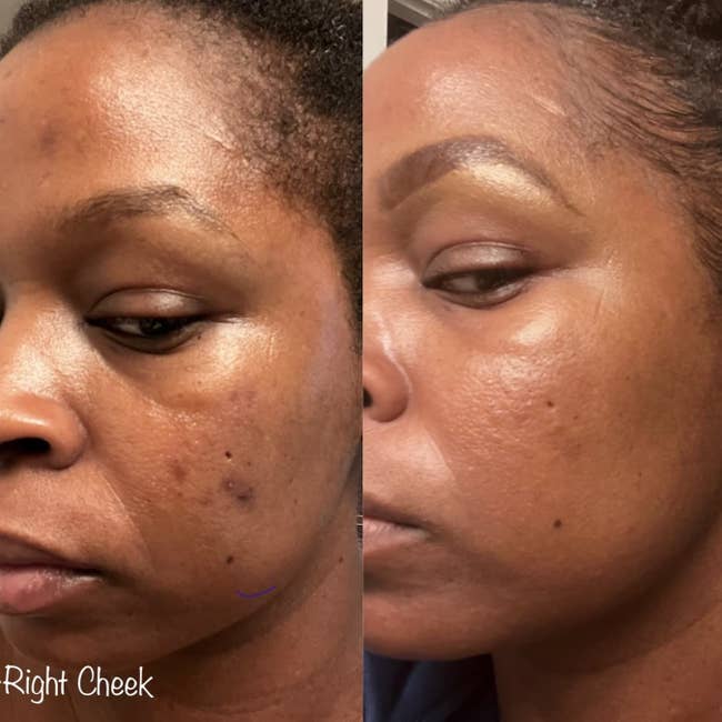 split image of reviewer's skin before and after using gel with noticeable differences and dark spots faded