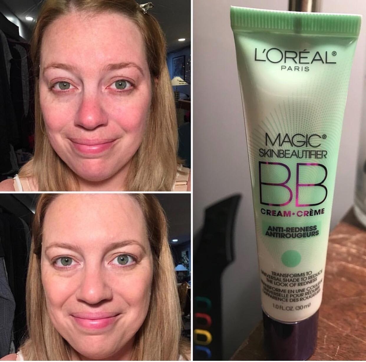 reviewer showing a before image with red skin and an after image with less red skin plus the bottle of cream