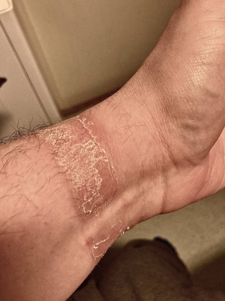 skin peeling where the watch was