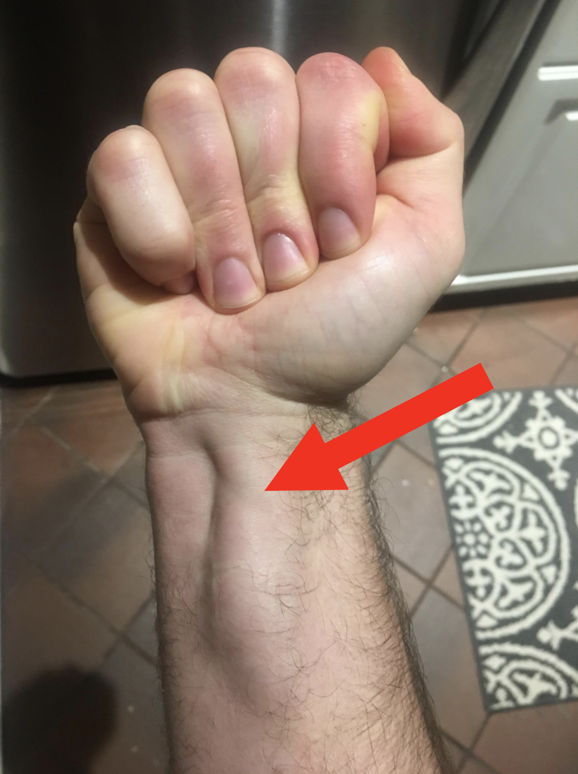 Arrow pointing to a growth in someone&#x27;s forearm