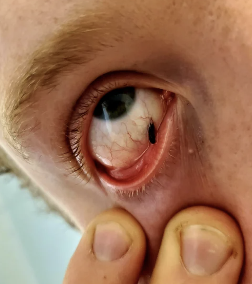 small bug in someone's eye