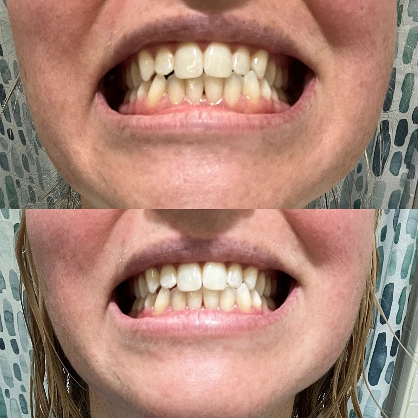 Reviewer showing teeth before and after using whitening strips